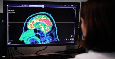 علماء يكتشفون مسار تفشي الزهايمر في الدماغ
