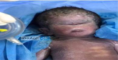 ولادة غريبة لطفل بعين واحدة شمال  الناصرية