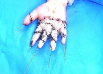 الشطرة: فريق طبي يتمكَّن من ترميم أصابع طفل فرمت اجزاءٌ منها 