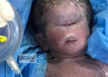 ولادة غريبة لطفل بعين واحدة شمال الناصرية